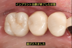サイナスリフト　歯科インプラントの骨再生・造成ののち、歯型をとり、被せ物が入ります